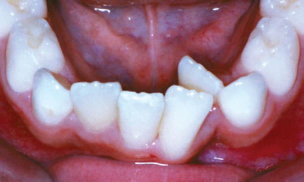 Crowding Janzen & Chwa Orthodontics in Northbrook, IL